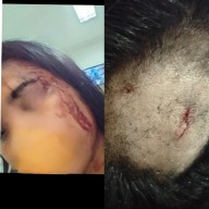 Kepala Wanita ini Bocor 8 Jahitan, Dipukul LC Pakai Botol Bir